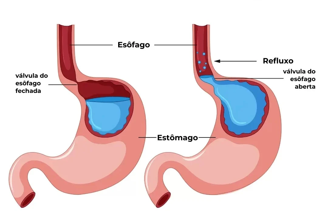 Doença do Refluxo Gastroesofágico (DRGE)